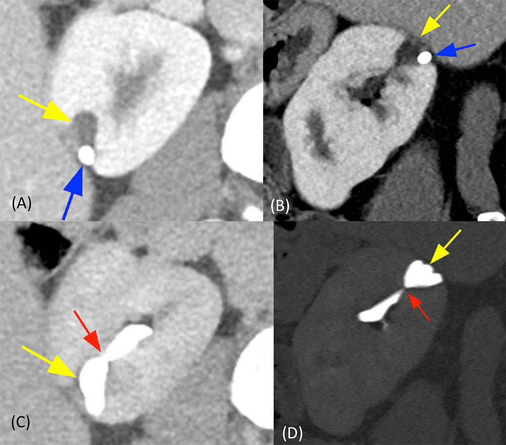 Calyceal Diverticulum